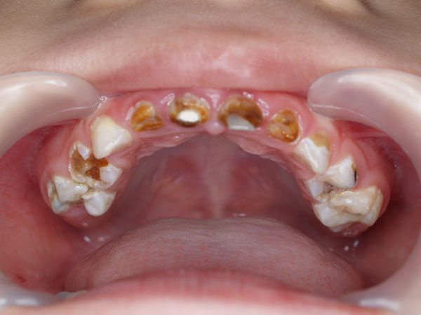 early-childhood-caries-oralcare