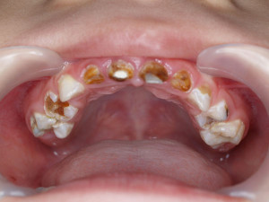 early-childhood-caries_photo_03
