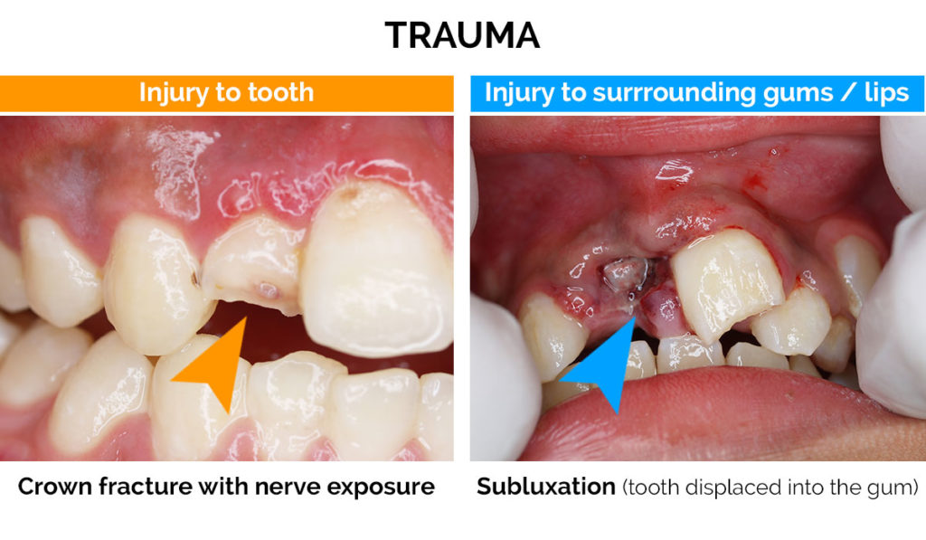 Dental trauma - oralcare