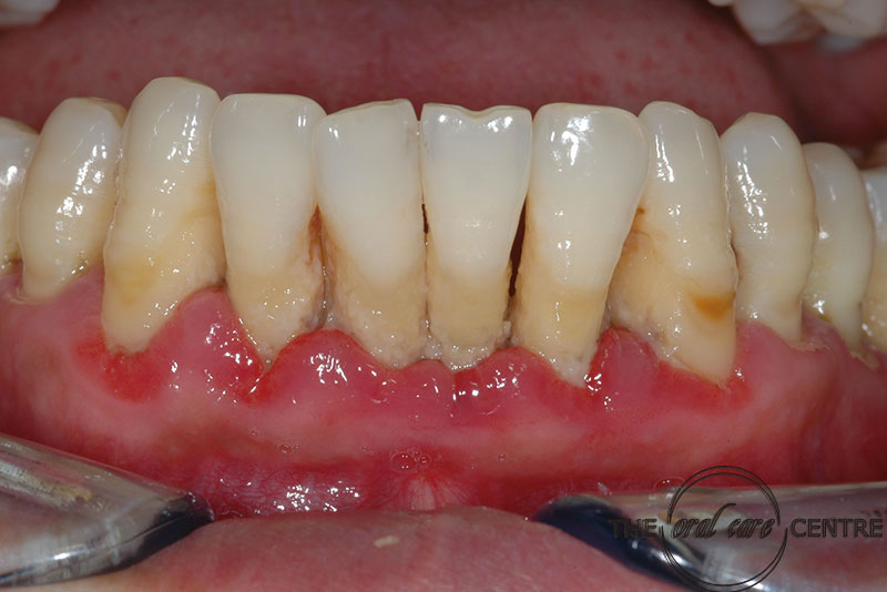 Red and Swollen Gums