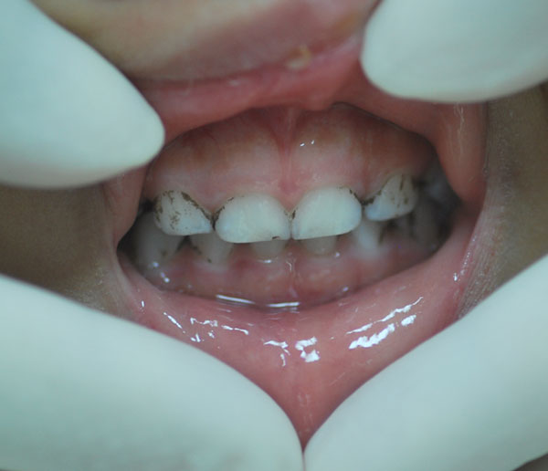 How To Remove Iron Stains From Baby Teeth?  