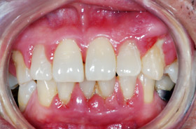 38 year old patient with periodontitis