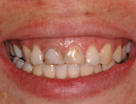 The patient shows the entire length of the front teeth when she smiles. This is called a high smile line and makes accurate placement of implants in the front difficult. There is no margin for error as an implant which is placed wrongly is easily noticeable as not being symmetrical to the rest.