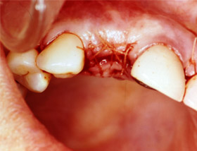 Graft material placed in the socket of the extracted front tooth with stitches in place