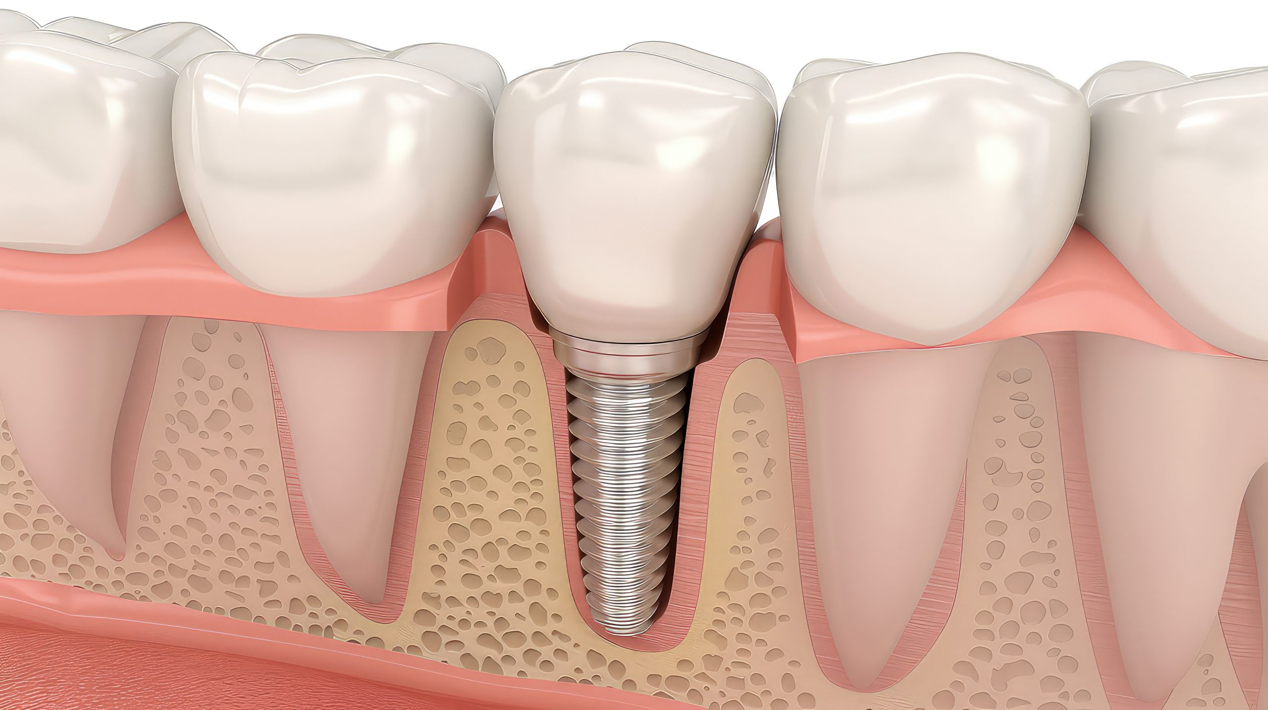 dental implants