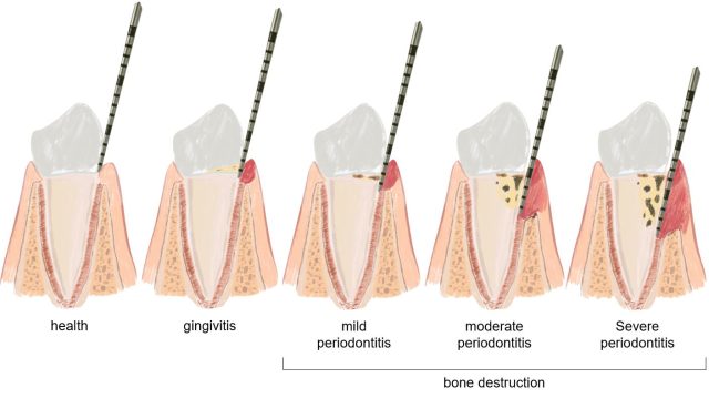 gum disease